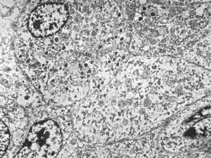 F,68y. | APUD carcinoma